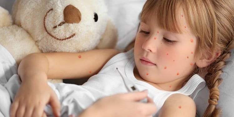 Cele mai frecvente boli virale la copii